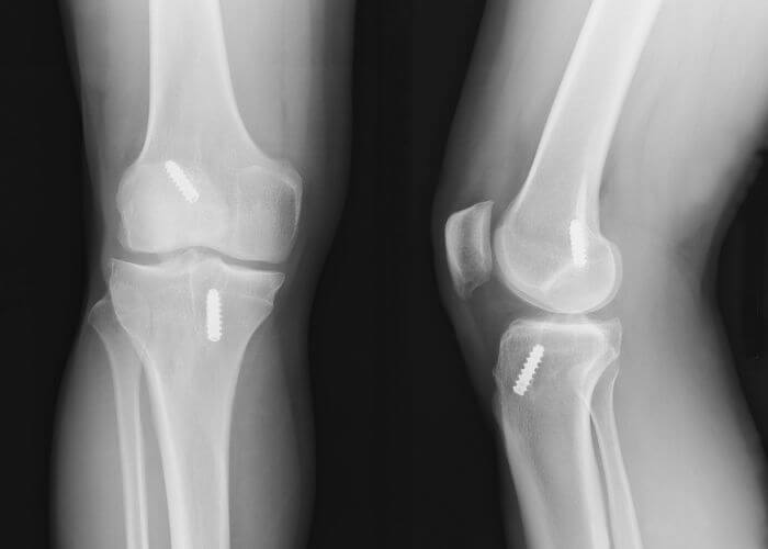 ACL Reconstruction | Vail CO