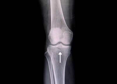 Tibial Eminence Fracture | Vail CO