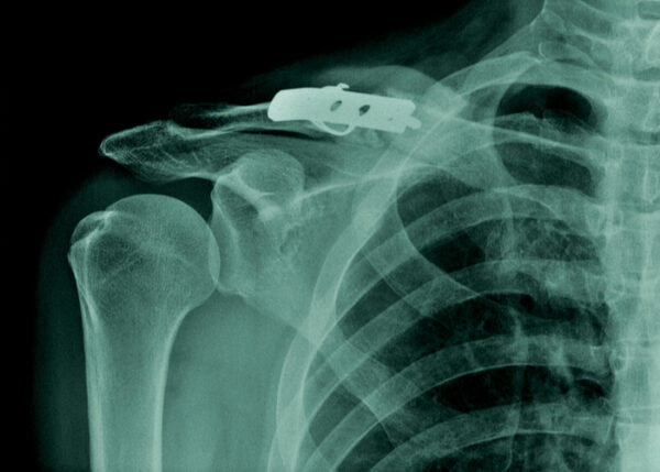Clavicle Fracture Fixation | Vail CO