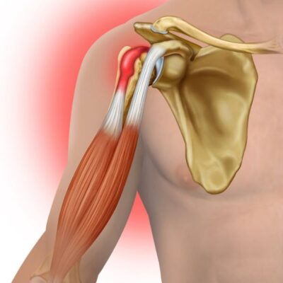 Distal Biceps Tendon | Vail CO