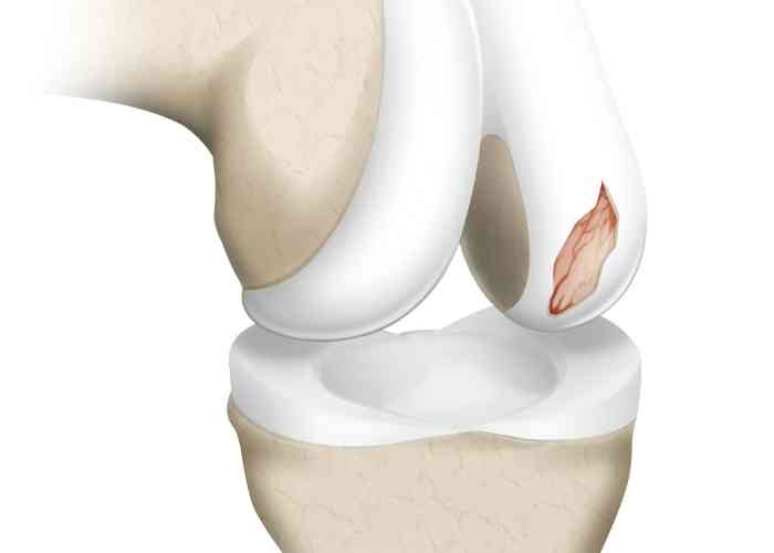Focal Cartilage | Vail CO