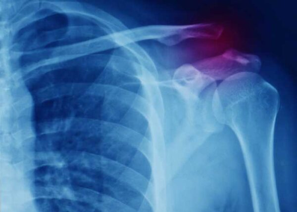 AC Joint Injury | Vail CO
