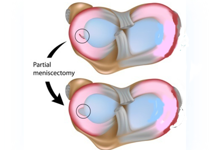 Partial Menisectomy | Vail CO