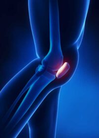 Patellofemoral Joint | Vail CO