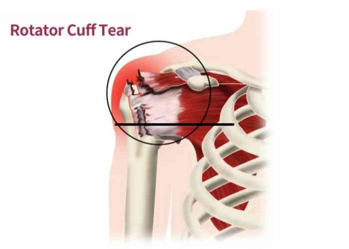 Anatomic description of degenerative rotator cuff tear. The common